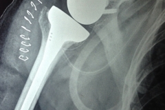 Reverse shoulder replacement