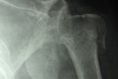 Shoulder fracture dislocation