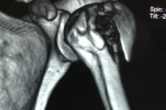 CT scan fracture shoulder
