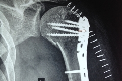 XRay after fracture shoulder fixation
