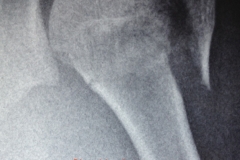 Xray fracture shoulder